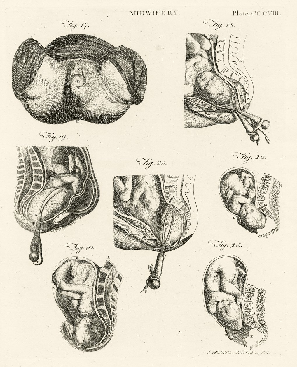 Barnmorskeyrket, illustration från "Encyclopedia Britannica", utgiven i Edinburgh 1798 (kopparstick). av Alexander Bell
