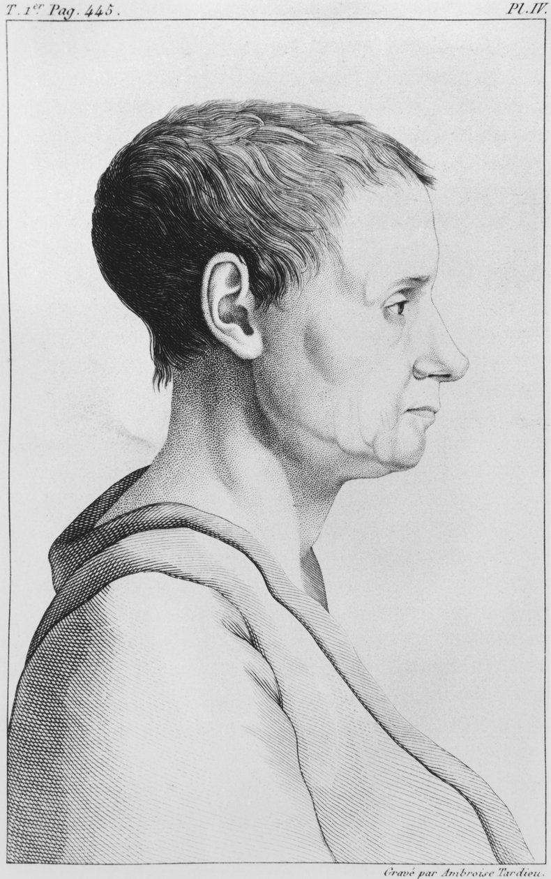 Theroigne de Mericourt, illustration ur "Des Maladies Mentales considerees sous le rapport medical, hygienique et medico-legal" av Etienne Esquirol (1772-1840), plansch IV, 1838. av Ambroise Tardieu