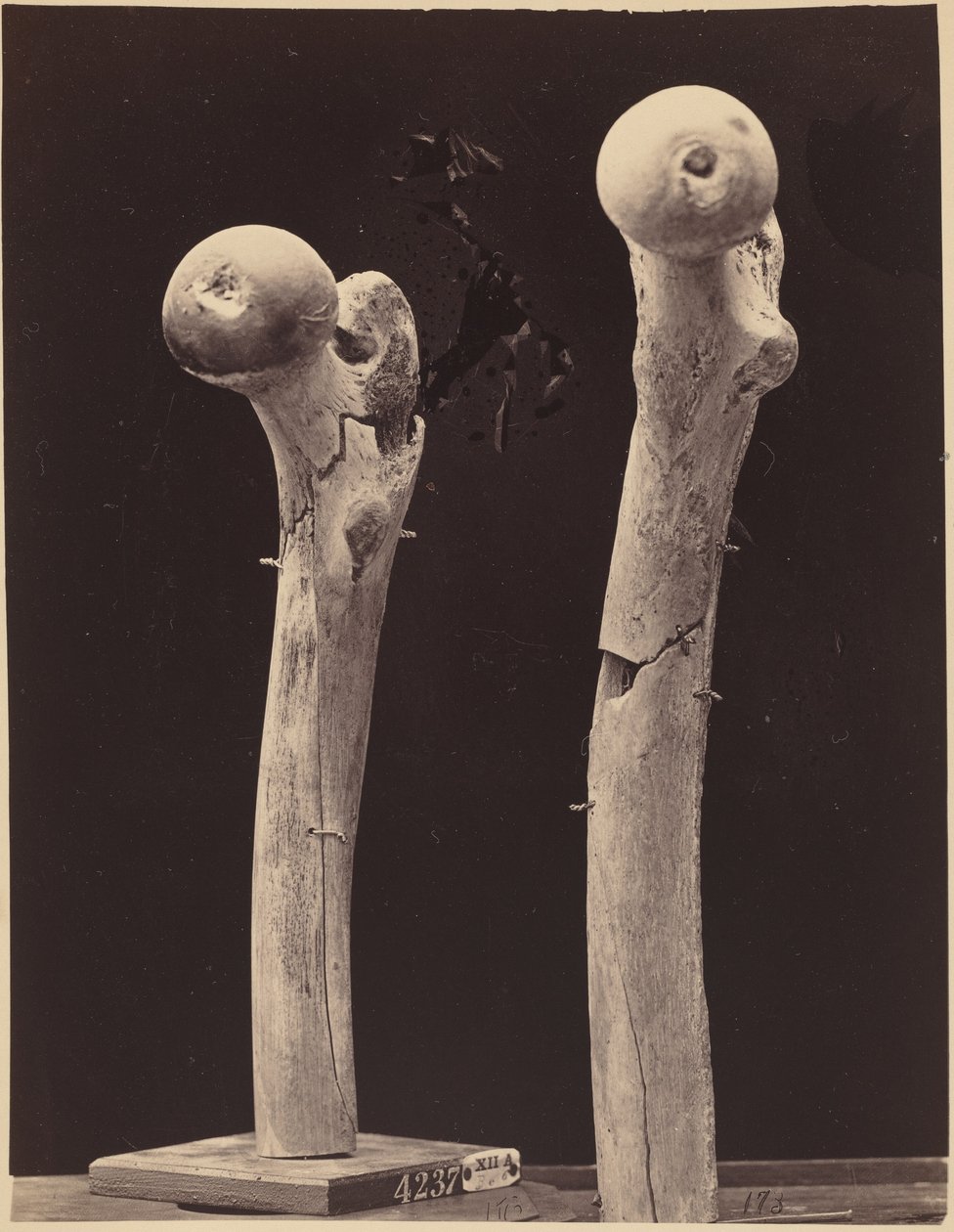Exemplar av skottfrakturer i lårbenet,ca. 1867 (foto) av American Photographer
