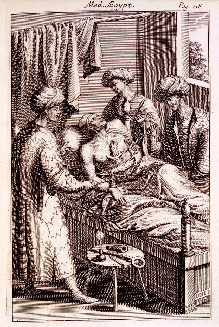 Illustration av moxibustion från Medicina Aegyptorum av Prospero Alpinus, 1745 av American School