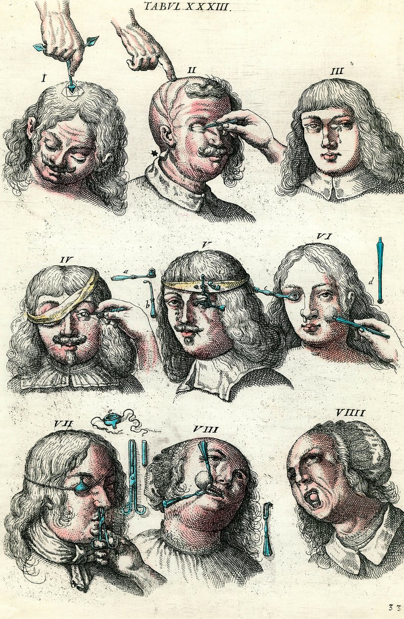 Kirurgi på 1700-talet: Trepanation och operation av öga och ansikte. Gravyr i "Institutions chirurgicale" av Lorenz Heister av Anonymous Anonymous