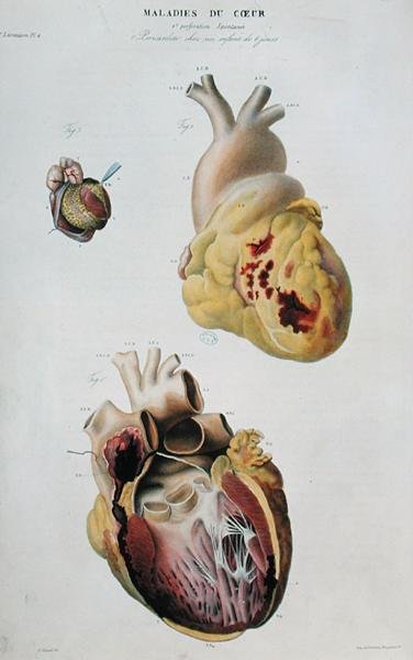 Tallrik föreställande hjärtsjukdomar. Spontan ruptur av hjärtat hos en 86-årig kvinna (fig. 1) och perikardit hos en sex dagar gammal baby (fig. 2), från 