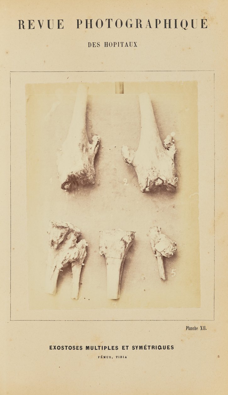 Multipla symmetriska exostoser, femur, tibia av Arthur de Montmeja
