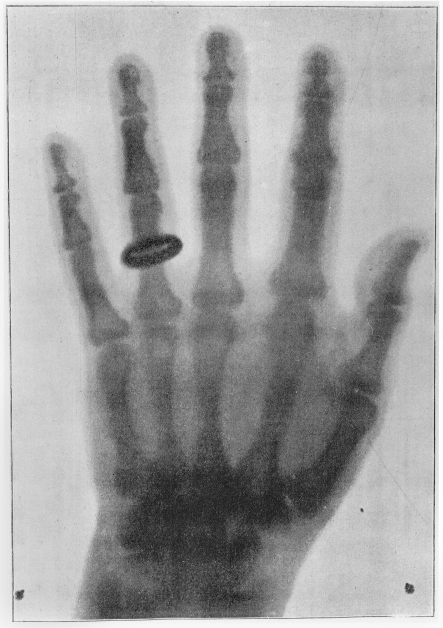 Röntgenbild av Anna Bertha Ludwigs, Röntgens hustrus, vänstra hand av Carl August Voller