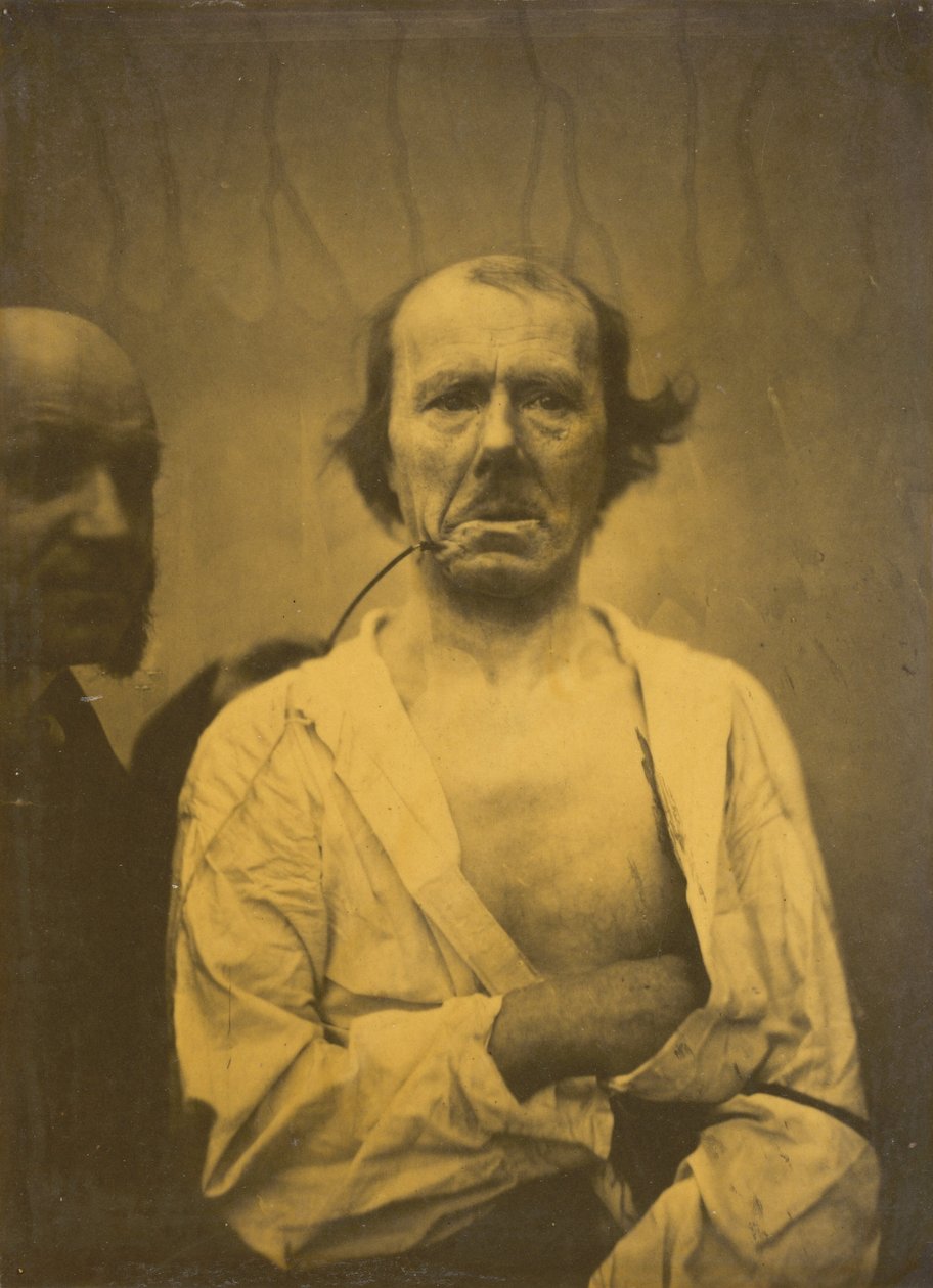 Ett avslappnat uttryck vänster, Avsky höger, 1854-1856, tryckt 1862. av Duchenne de Boulogne