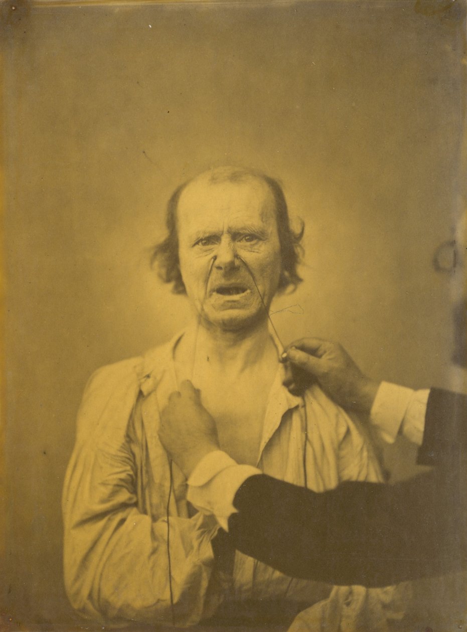 Missnöje, dålig humor, 1854-1856, tryckt 1862. av Duchenne de Boulogne