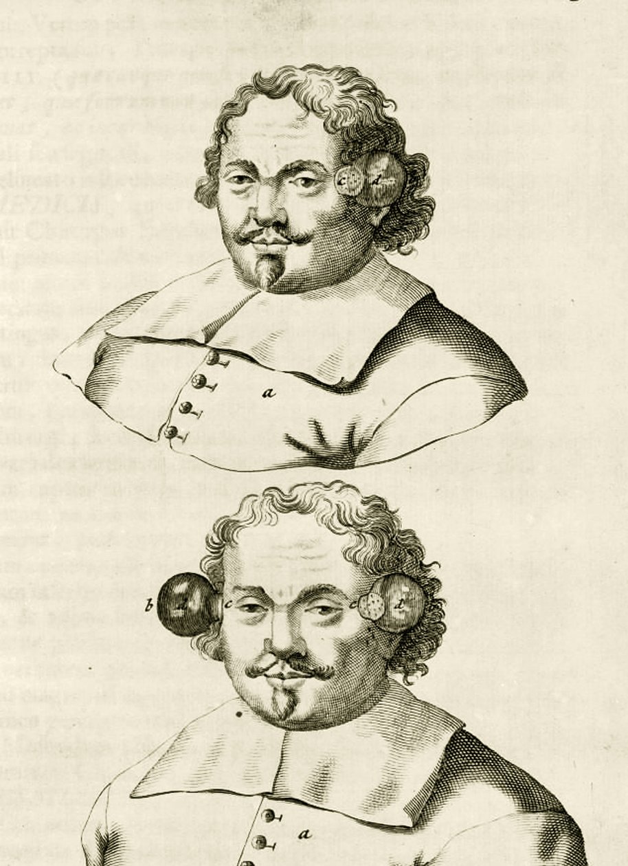 Ett exempel på koppning, från The Practice of Medicine av Frederik Dekkers, 1694 av Dutch School