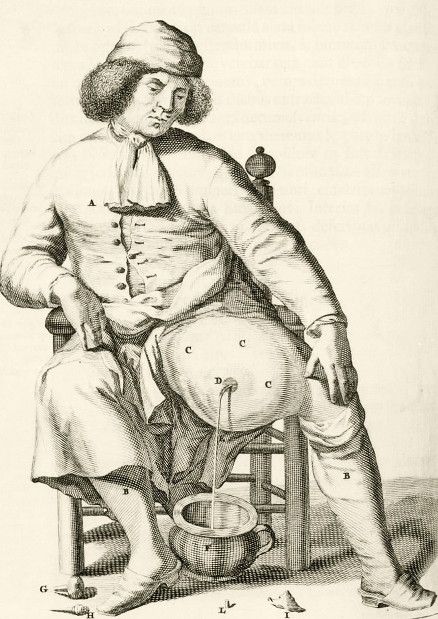 Dränering av vätska från en abscess av Frederik Dekkers, 1694 av Dutch School