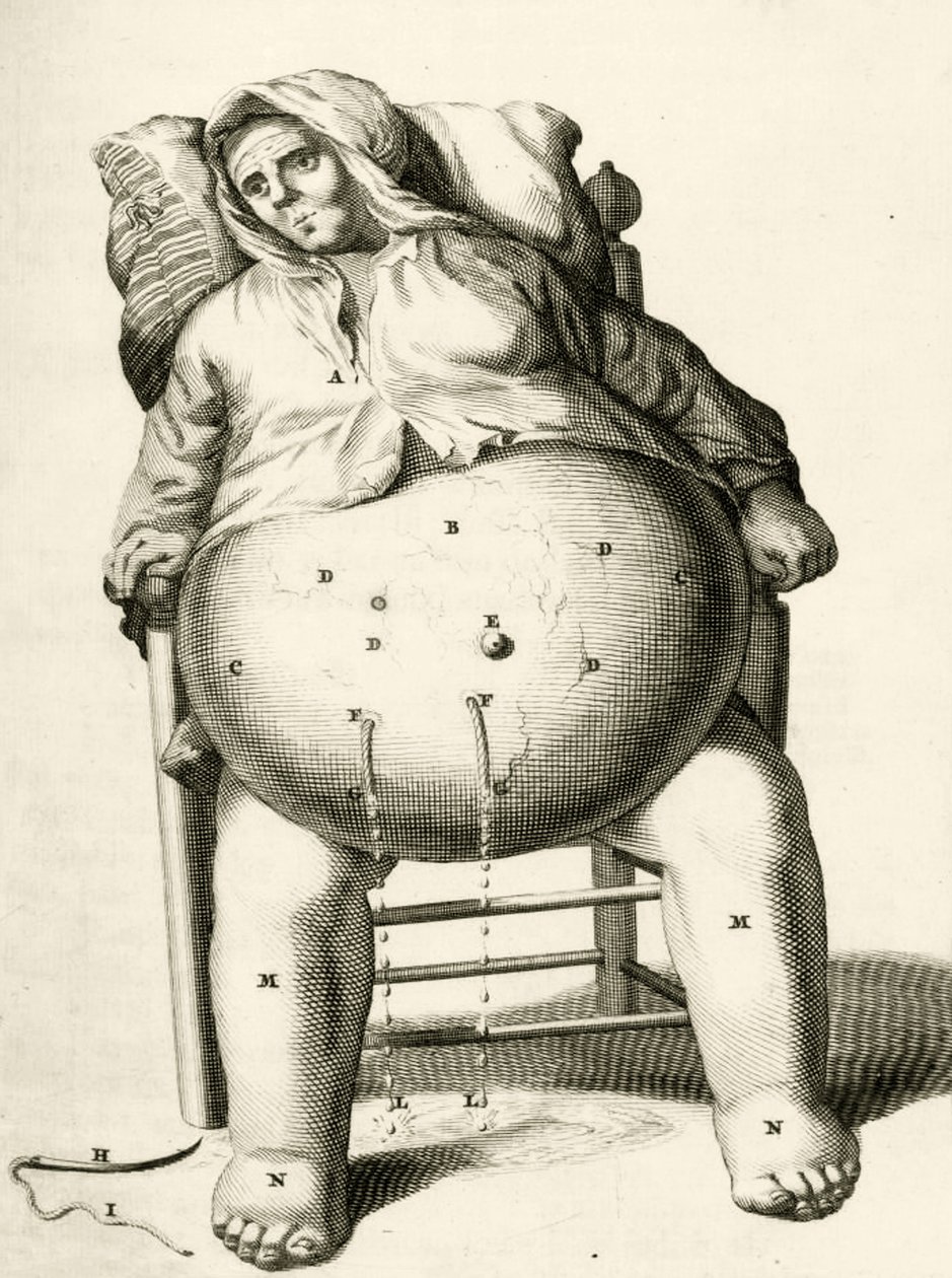 Dränering av vätskor från en abscess av Frederik Dekkers, 1694 av Dutch School