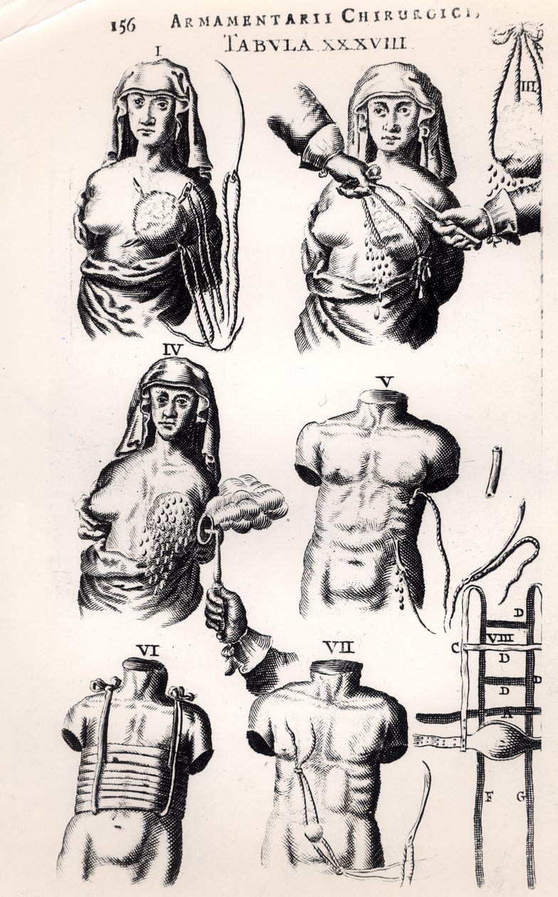 Opererar på bröstcancer, från Armamentarii Chirurgici av Johannes Schultes (1595-1645) publicerad i Amsterdam, 1672 av Dutch School