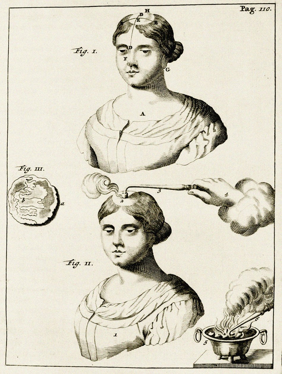 Behandling av en lidande av epilepsi, från Exercises in the Practice of Medicine av Frederik Dekkers, 1694 av Dutch School