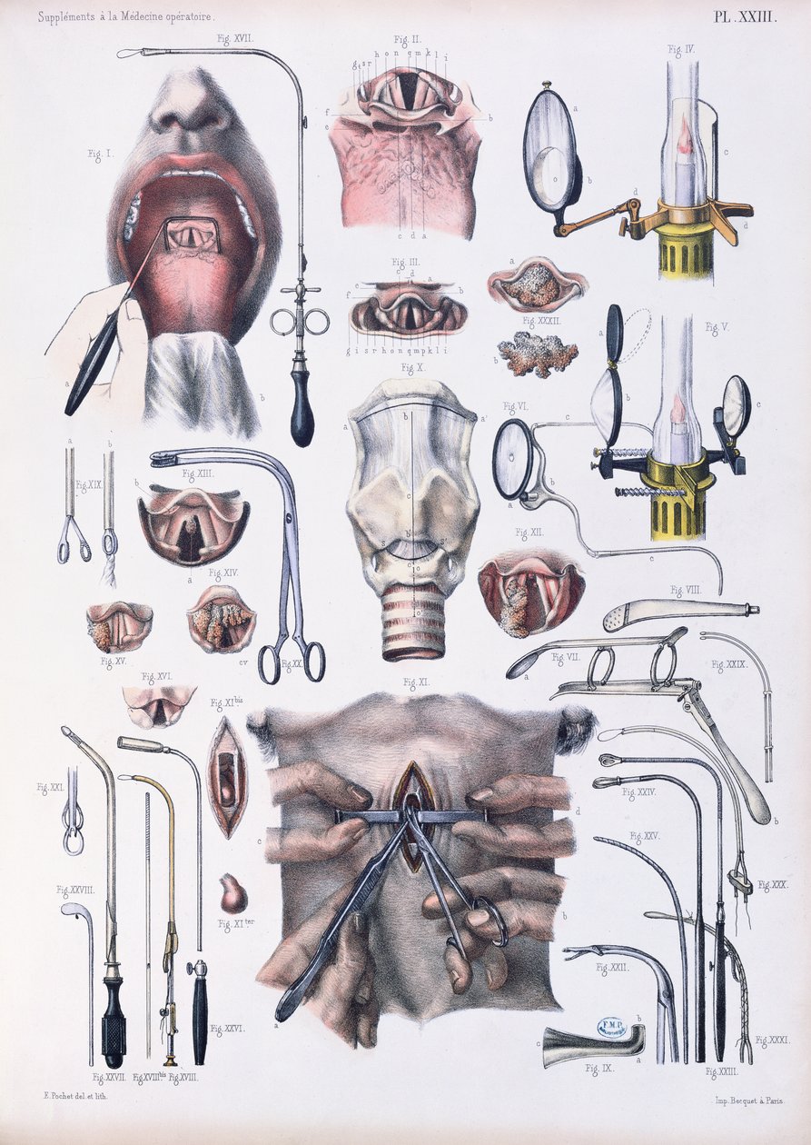 Trakeotomioperation, tallrik från 