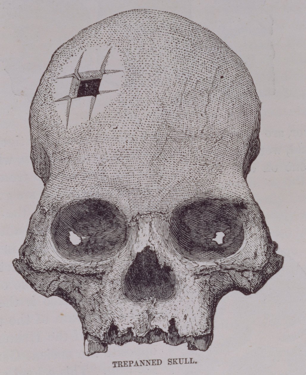 Trepanned Skull, från "Incidents of Travel and Exploration in the Land of the Incas" av E. George Squier, pub. år 1878 av English School