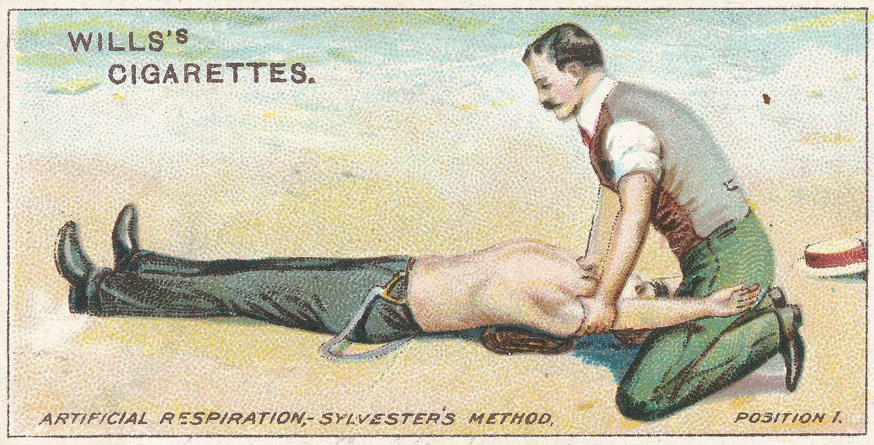 Artificiell andning, Sylvester
