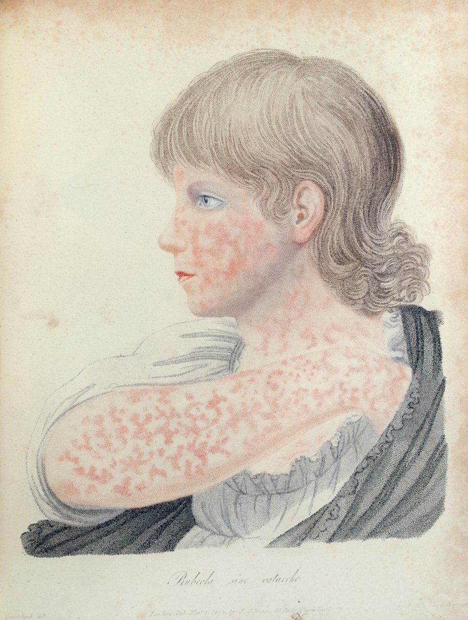 Tysk mässling, illustration till en bok av Robert Willan (1757-1812), 1808 (färgstick) av English School