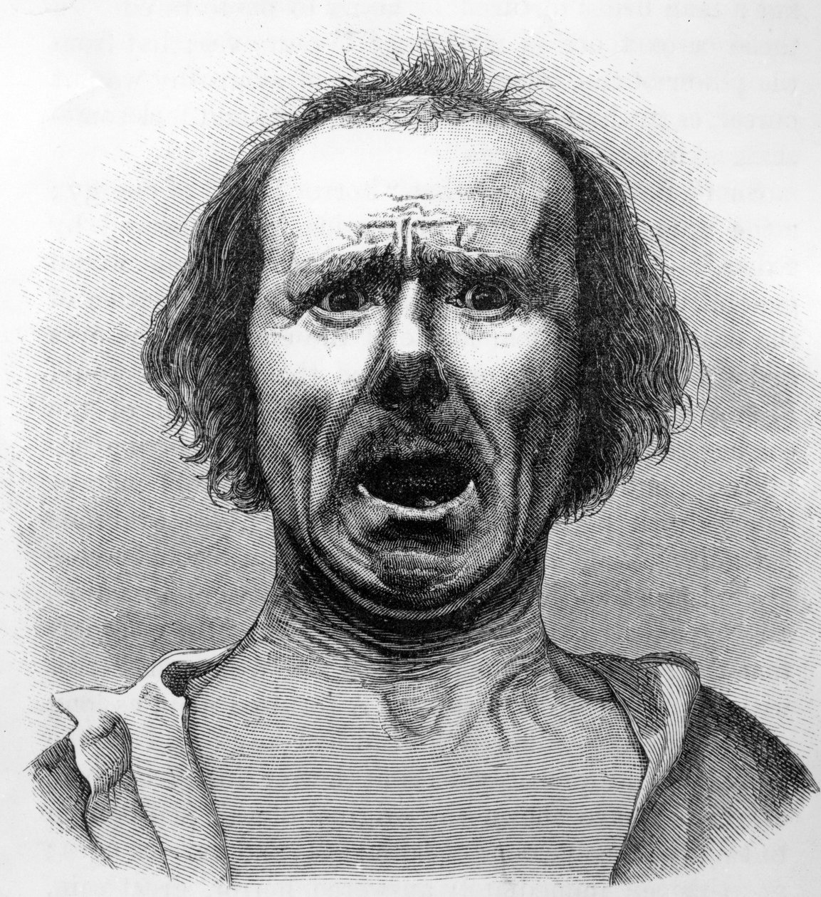 Skräck och ångest, kopierad från ett fotografi av Dr. Duchenne, illustration från 