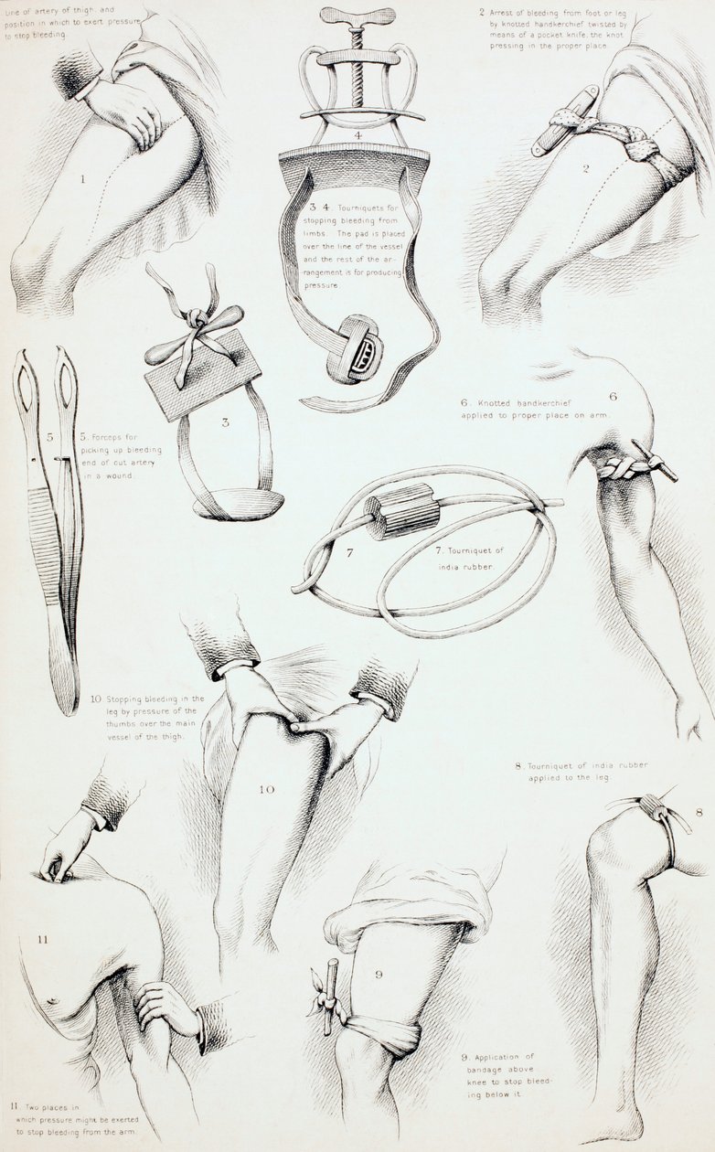Metoder för att arrestera blödning, c.1890 av English School