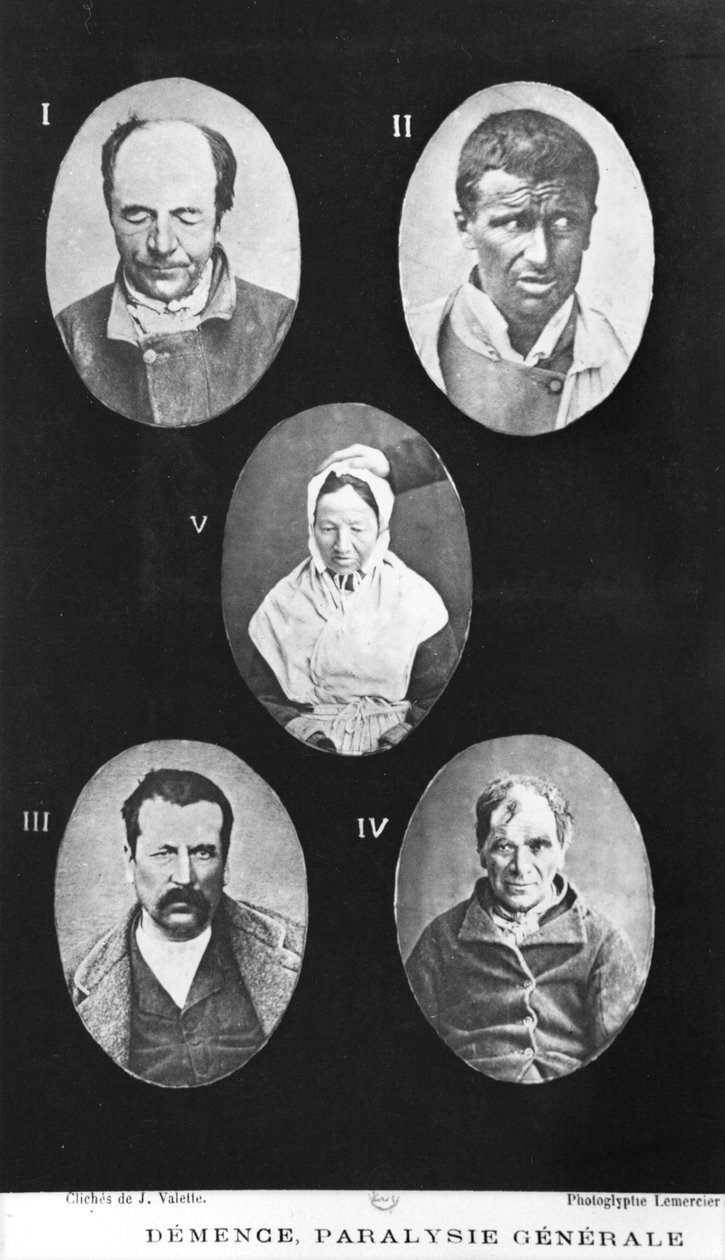 Demens, General Paralysis, illustration från Ny elementär och praktisk avhandling om psykiska sjukdomar av Henri Dagonet (1823-1902) Paris, Bailliere, 1876 av French Photographer