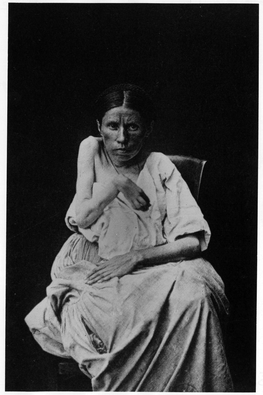 Fotografi av en patient som lider av hemiplegisk epilepsi, -i "" fotografisk ikonografi av Salpetrière, Bourneville och P. Regnard, Paris av French Photographer