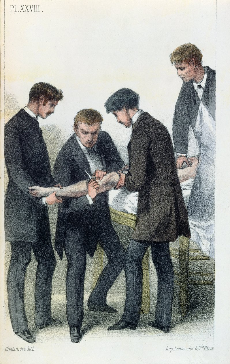 Amputera en arm, från en medicinsk manual av Jean-Baptiste-Leon Dubreuil, ca 1850-60 av French School