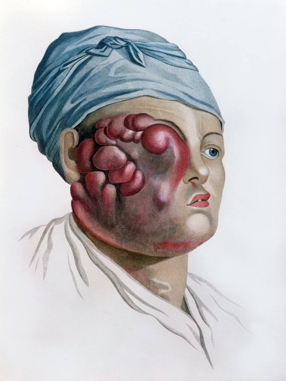 Cancerous scrofula, från Description des Maladies de la Peau av Baron Jean Louis Alibert (1768-1837) Paris, 1806 av French School
