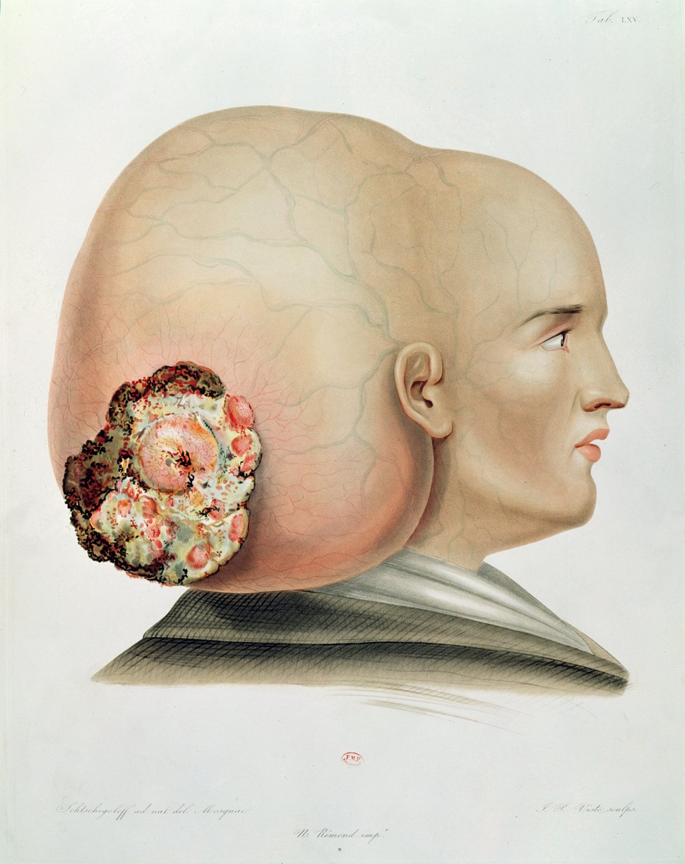 Svamp från dura mater, från Selecta Praxis Medico-Chirurgica av Alexander Auvert, Paris, 1856 av French School