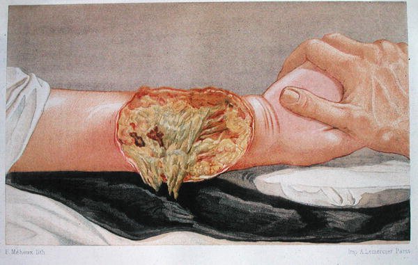 Hospital Gangrene, från "Traite de Chirurgie de Guerre" av Edmund Delorme (1847-1929), graverad av F. Meheux. av French School