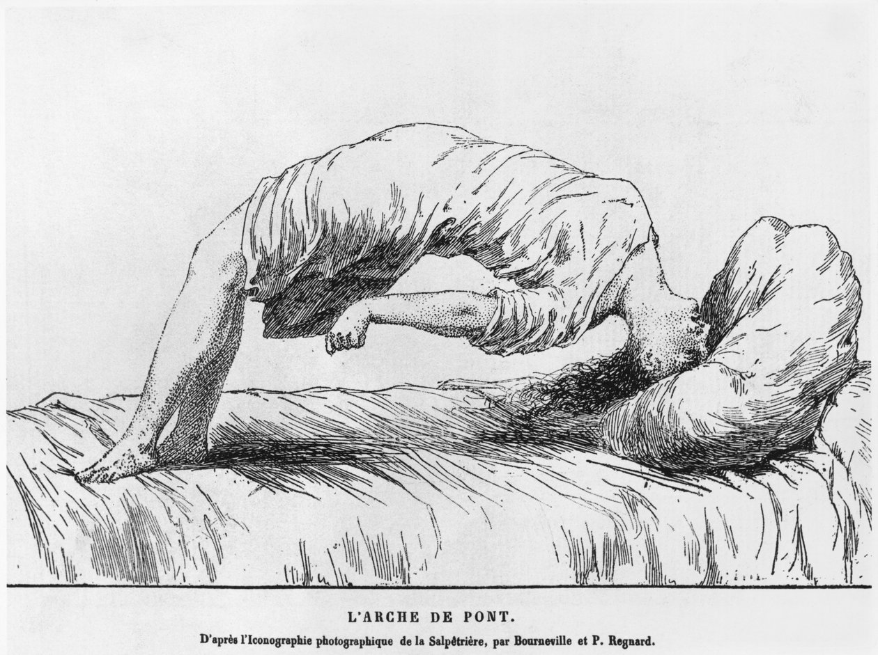 Hysteri och somnambulism, från Les Maladies Endemiques de l