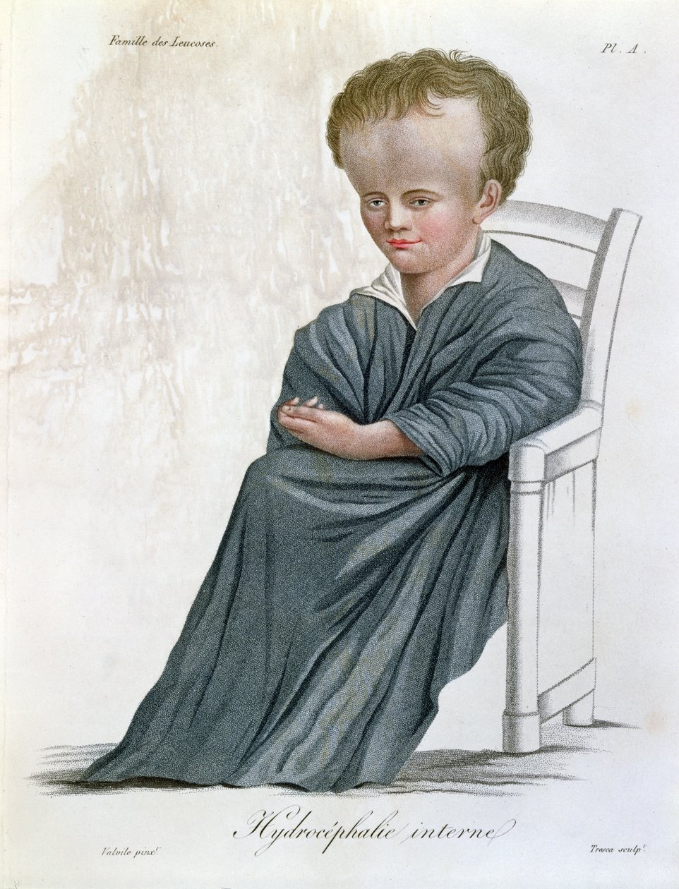 Intern Hydrocephalus, från Nosologie Naturelle av Baron Jean Louis Alibert (1768-1837) graverad av Tresca, 1817 av French School