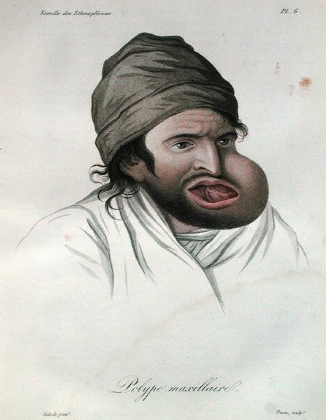 Maxillär polyp, från en bok av Baron Jean Louis Alibert (1768-1837) 1817 (färgad gravyr) av French School