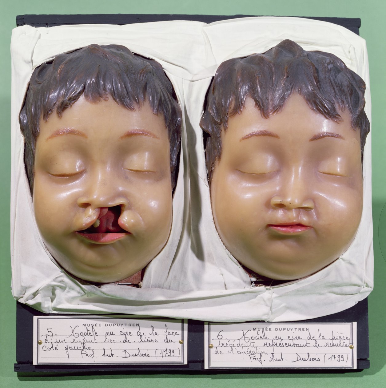 Modell som visar ett barns ansikte före och efter en operation för att korrigera en hareläpp utförd av Antoine Dubois (1756-1837) 1799 (vax) av French School