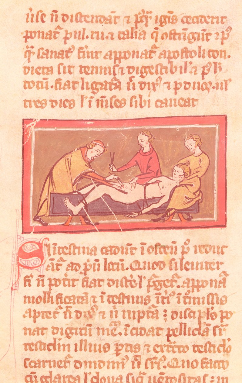 Ms H 89 fol.23 Surgery, från en upplaga av Book of Surgery av Rogier de Salerne av French School