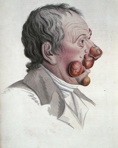 Mycosis Fongoide, från en bok av Baron Jean Louis Alibert (1768-1837) 1838 (färgad gravyr) av French School