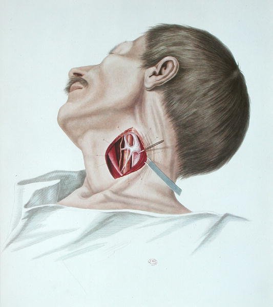 Operation på ett aneurysm, från "Selecta Praxis Medico-Chirurgica" av Alexander Ouvert, Paris av French School