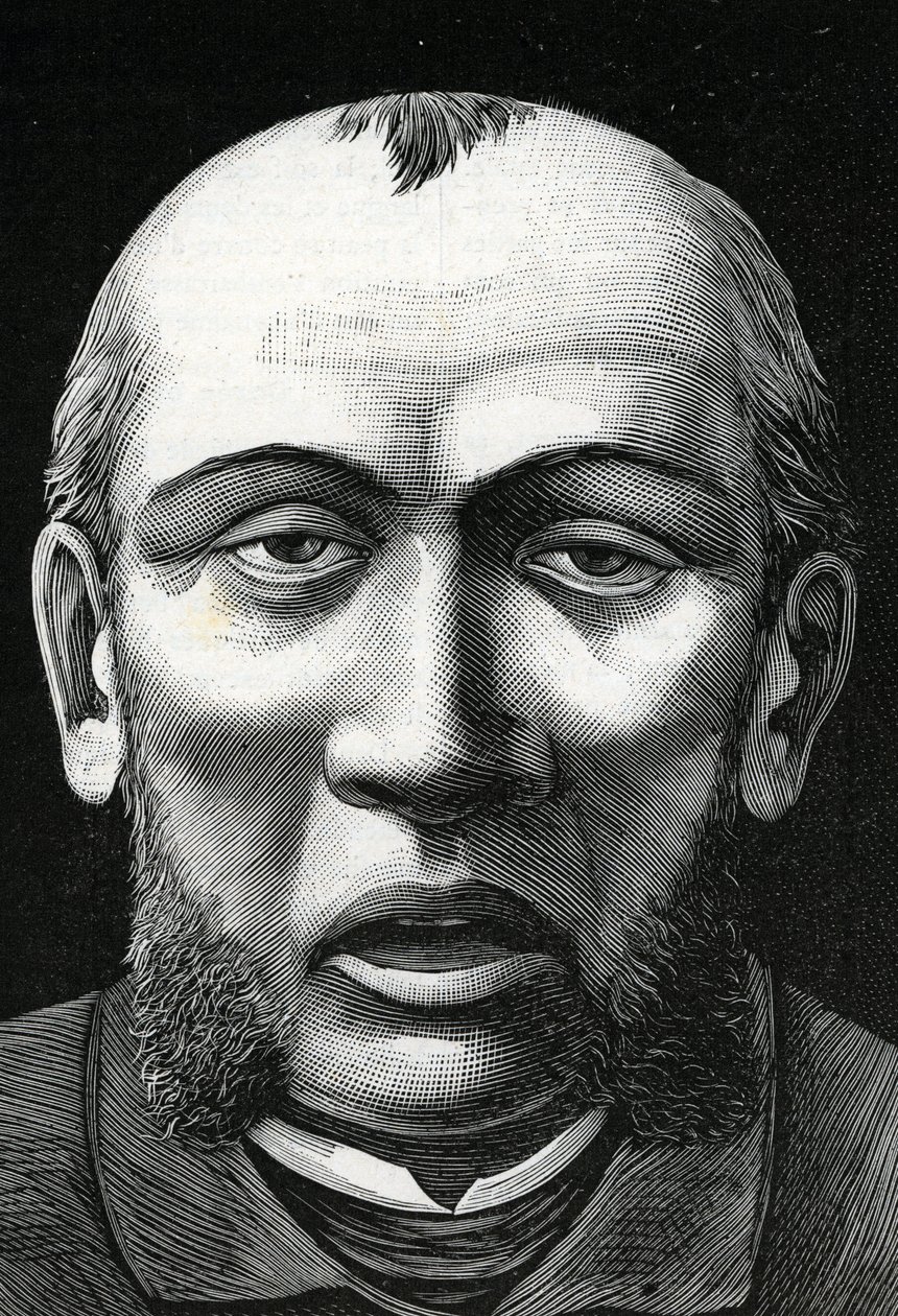 Patient med cerebral uppmjukning (gravyr) 1888 av French School