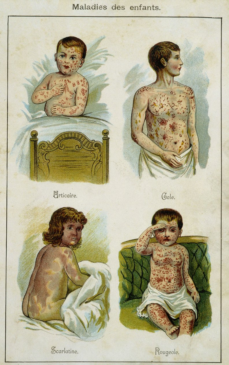 Tallrik som illustrerar barns sjukdomar: nässelutslag, skabb, scharlakansfeber och mässling (drag från Bilz, naturlig medicin) sent 1800-tal. av French School