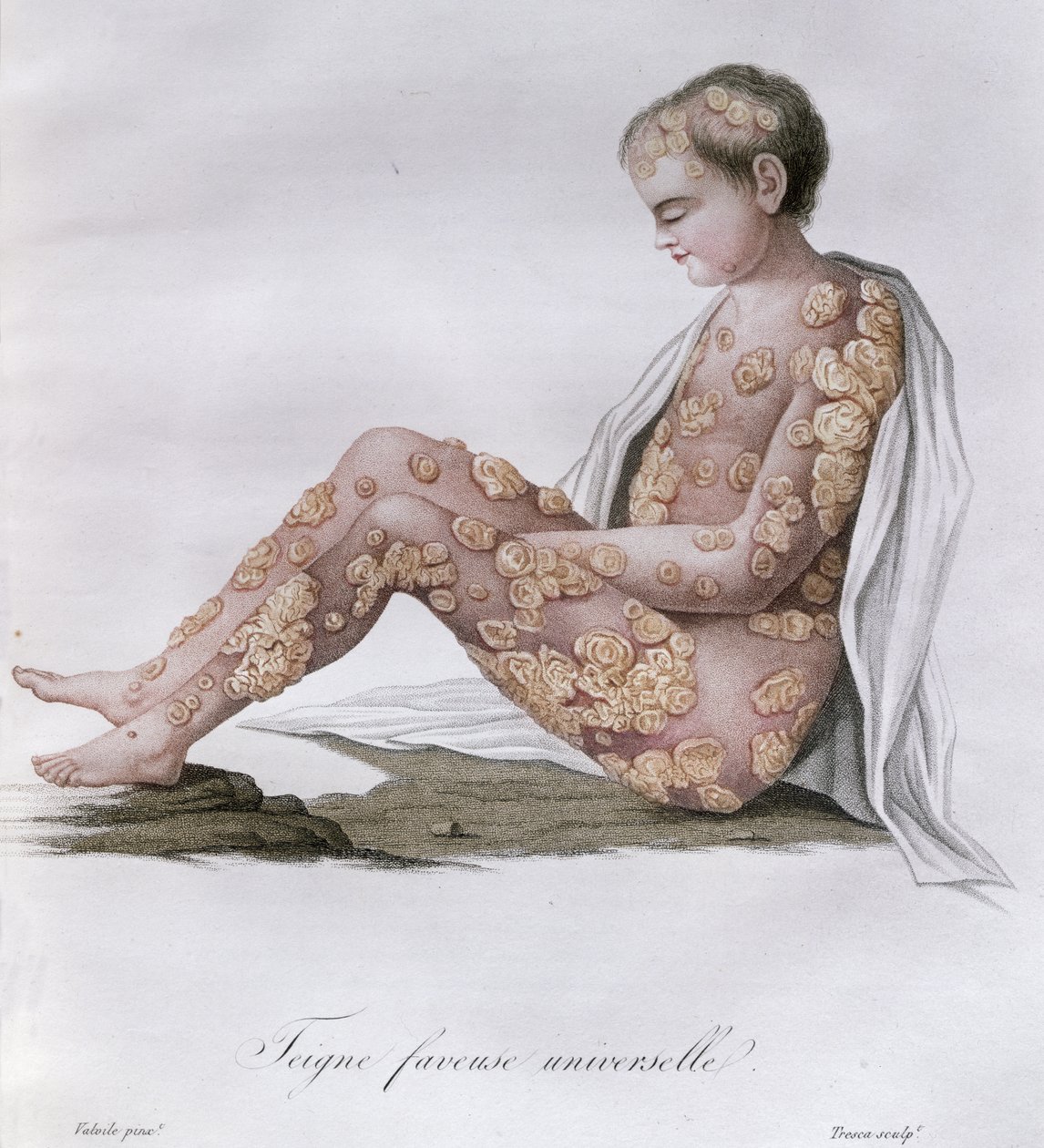 Ringorm, från en bok av Baron Jean Louis Alibert (1768-1837) 1838 av French School