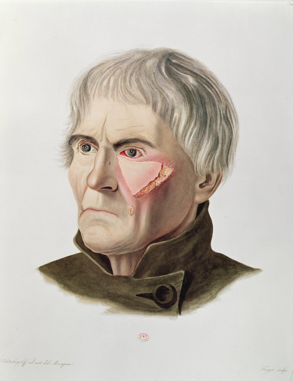 Hudtransplantatoperation, från Selecta Praxis Medico-Chirurgica av Alexander Auvert, Paris, 1856 av French School