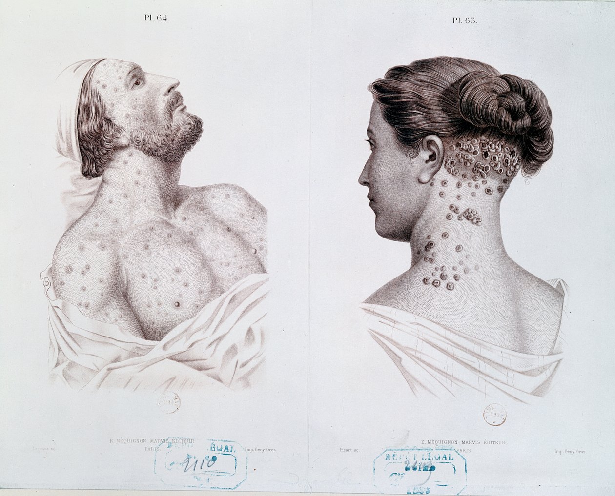 Symtom på syfilis hos män och kvinnor, från en medicinsk bok, c.1850-60 av French School