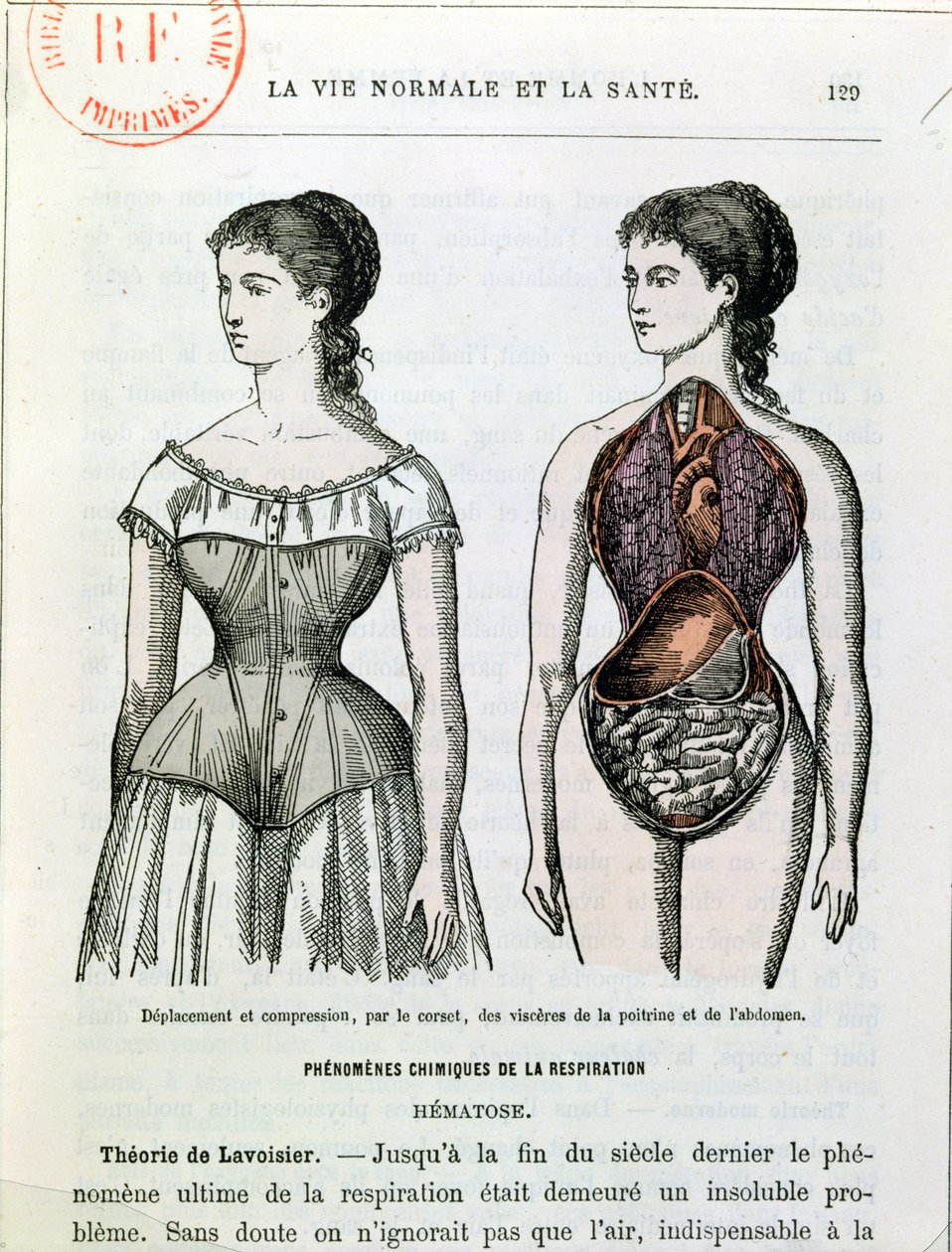 Korsettens skadliga effekter, illustration från La Vie Normale et la Sante av Dr Jules Rengade (f.1841) ca 1880 av French School