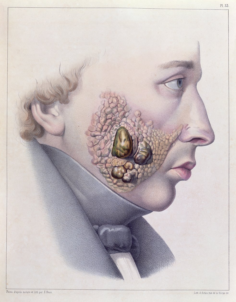 Ansiktssymptomen vid könssjukdom, från Traite Complet des Maladies Veneriennes av Philippe Ricord (1800-89) 1851 av French School