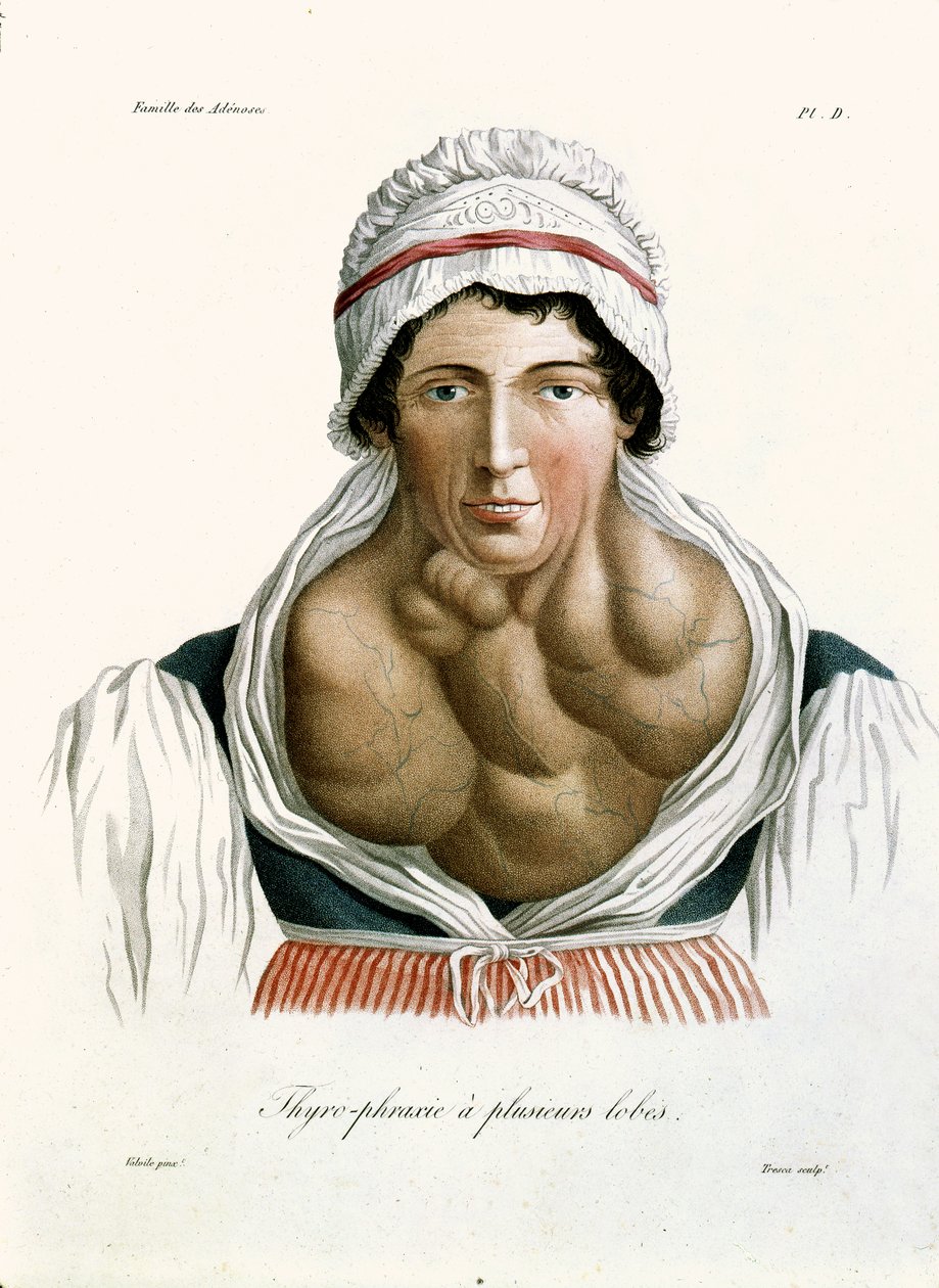 Sköldkörtelsjukdom, från en bok av Baron Jean Louis Alibert (1768-1837) 1817 av French School