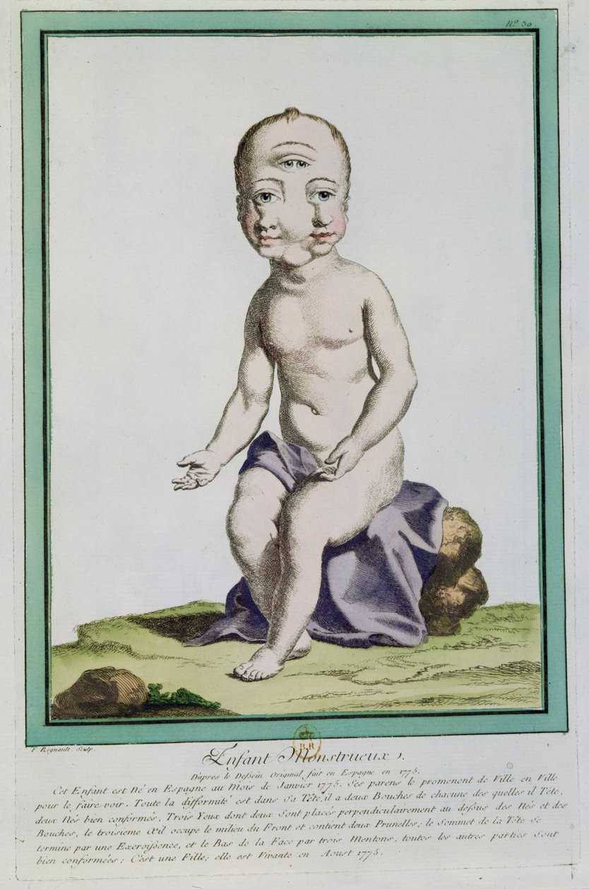 Barn med missbildat huvud, från "Les Ecarts de la Nature", Paris, 1775 av Genevieve Regnault de Nangis