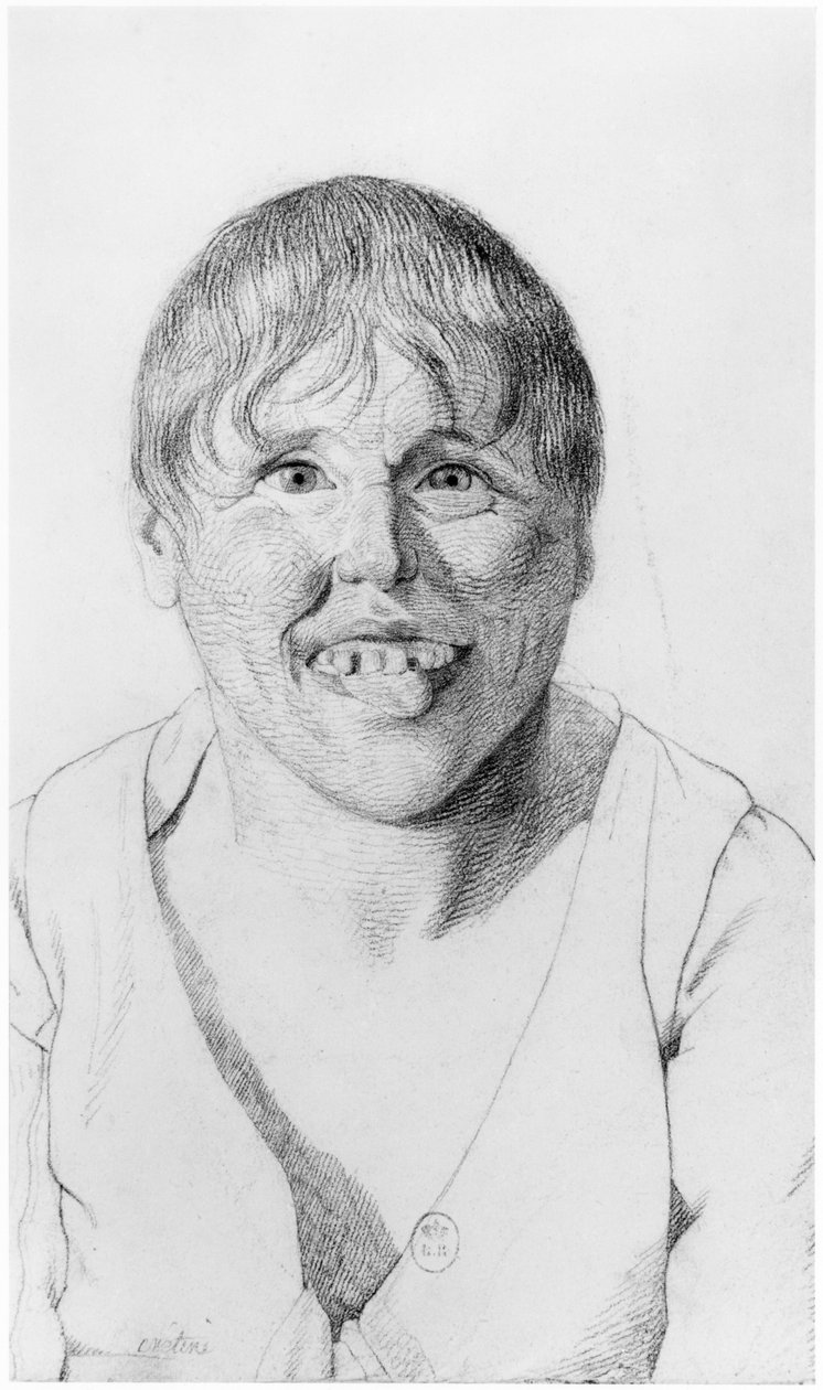 Cretin, framifrån, illustration från en opublicerad avhandling av Jean Etienne Dominique Esquirol (1772-1840) om de sinnessjuka på Salpetriere-anstalten, omkring 1818. av Georges Francois Gabriel