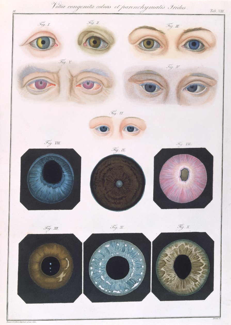 Beskrivning av medfödda ögonavvikelser, från kliniska presentationer av det mänskliga ögats sjukdomar och synfel, av Friedrich August von Ammon (1799-1861) 1838 av German School