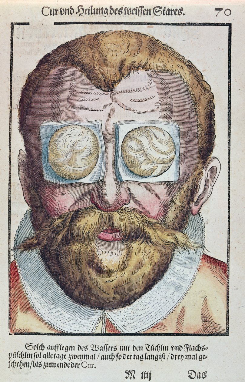 Treating an eye condition, från Ophthalmodouleia av Georg Bartisch (1535-1636) publicerad i Dresden 1583 (träblock i färg) av German School