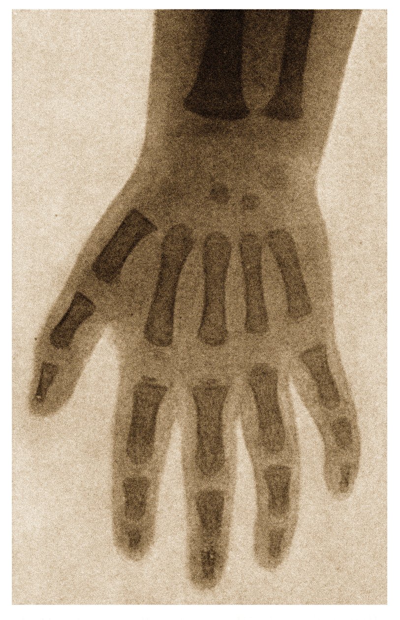 Röntgen av ett barns hand c.1890 av German School