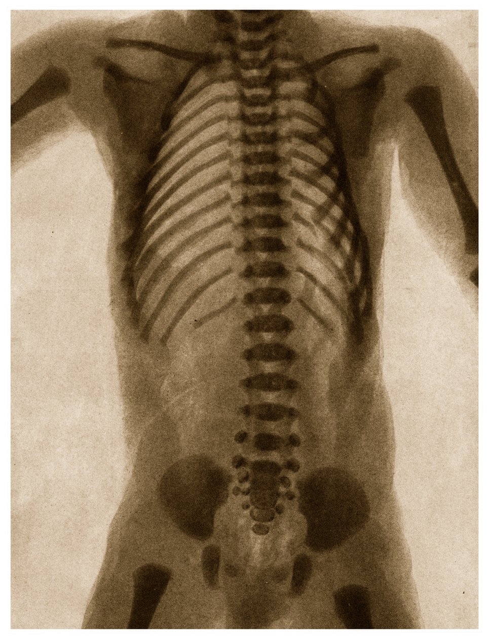 Röntgen av en mänsklig torso c.1890 av German School