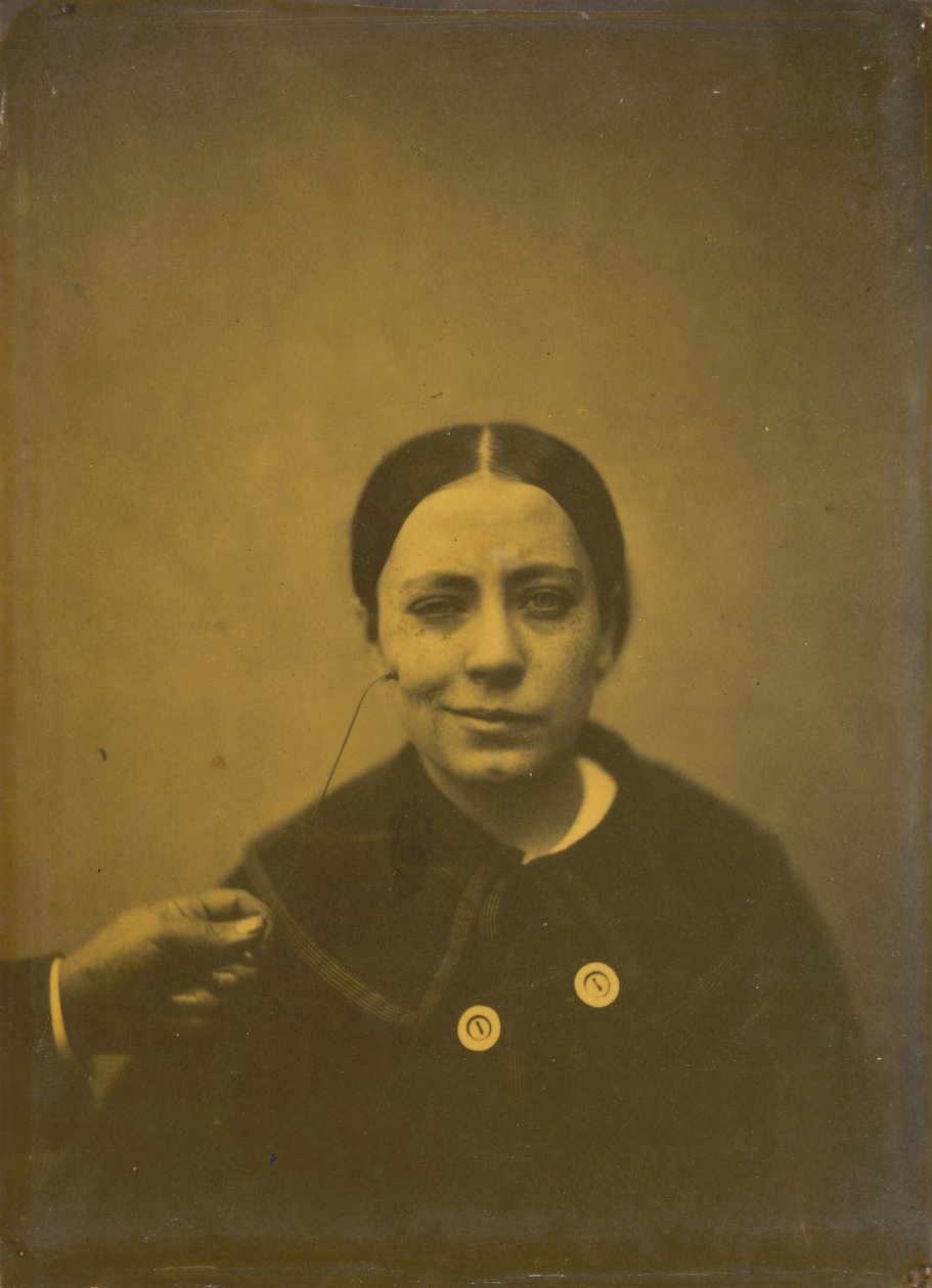 Lätt sänkning av munvinkeln på grund av depression (vänster); Falskt skratt (höger),1854-1856, tryckt 1862 (foto) av Guillaume Benjamin Armand Duchenne de Boulogne