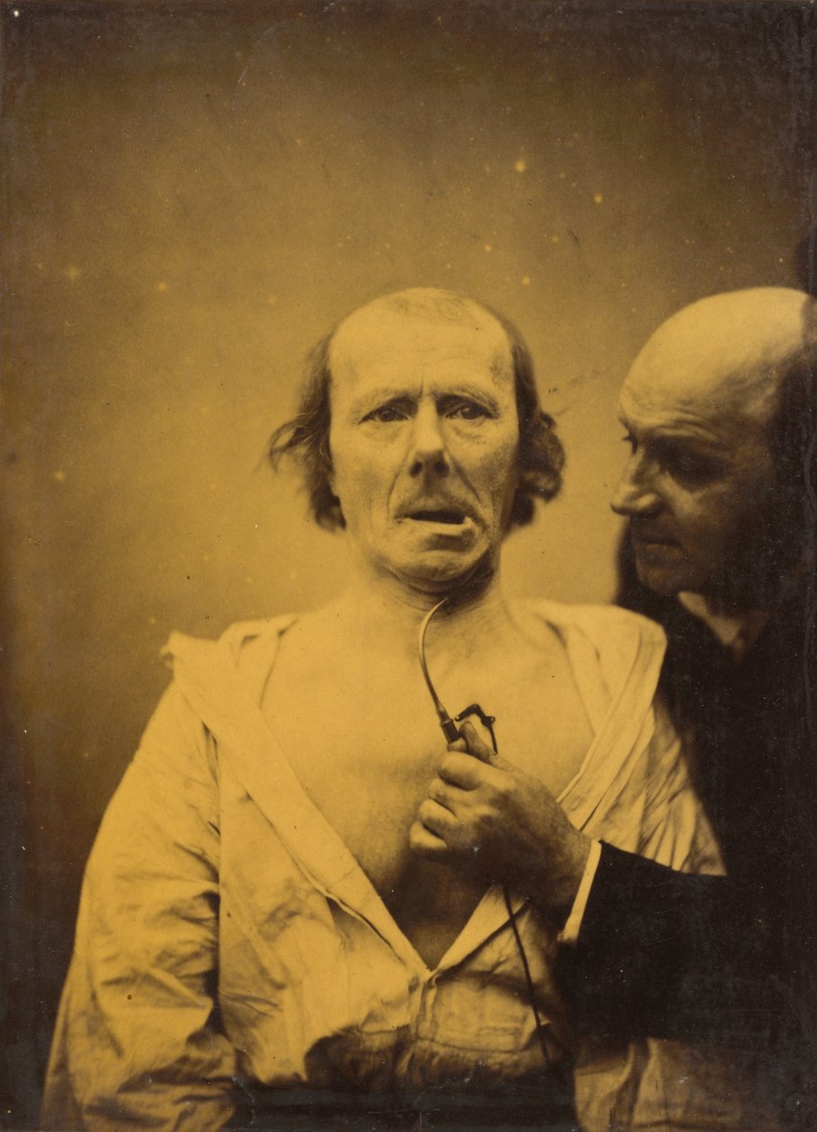 Denna sammandragning av m. bara platysma saknar uttryck av Guillaume Benjamin Amant Duchenne